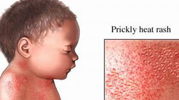 Trị rôm sảy ở trẻ nhỏ ảnh 1 Trị rôm sảy ở trẻ nhỏ ảnh 1