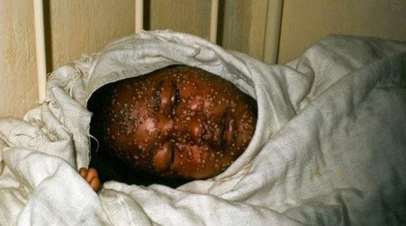Những hình ảnh khủng khiếp về dịch bệnh Ebola ảnh 5 Những hình ảnh khủng khiếp về dịch bệnh Ebola ảnh 5