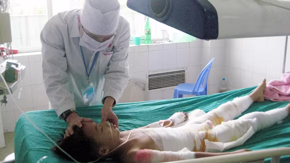Nhiều trẻ nguy kịch vì bỏng ảnh 1 Nhiều trẻ nguy kịch vì bỏng ảnh 1