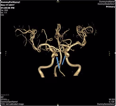 Hình ảnh chuỗi xung mạch não (MRA tof 3D) của một bệnh nhân nữ 54 tuổi sàng lọc mạch não phát hiện túi phình động mạch (vị trí mũi tên) và đã được can thiệp nút túi phình động mạch não phải tại Vinmec