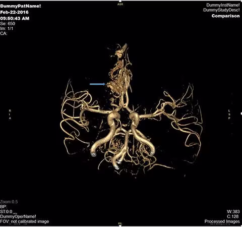 Hình ảnh dị dạng thông động tĩnh mạch vùng trán phải của một bệnh nhân nam 40 tuổi. Bệnh nhân đã được can thiệp nút khối dị dạng tại Vinmec và hồi phục sức khỏe tốt