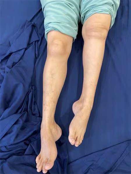 (Hình ảnh bệnh nhân trước khi mổ) Chân trái ngắn hơn chân phải khoảng 10cm, bệnh nhân không thể đi lại bằng chân trái (Hình ảnh bệnh nhân trước khi mổ) Chân trái ngắn hơn chân phải khoảng 10cm, bệnh nhân không thể đi lại bằng chân trái