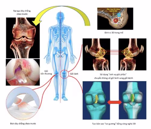 Phương pháp “ánh xạ giải phẫu” sử dụng công nghệ định vị 3D trong phẫu thuật tái tạo dây chằng chéo trước (hình minh hoạ) Phương pháp “ánh xạ giải phẫu” sử dụng công nghệ định vị 3D trong phẫu thuật tái tạo dây chằng chéo trước (hình minh hoạ)