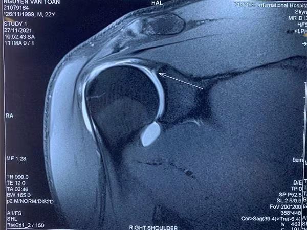 Phim MRI khi có tiêm thuốc thấy rõ tổn thương hơn Phim MRI khi có tiêm thuốc thấy rõ tổn thương hơn