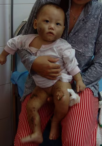 Bé Như Ý với những vết thương trên cơ thể do chính mẹ đẻ gây ra