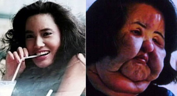 Những thảm họa kinh hoàng từ phẫu thuật thẩm mỹ ảnh 8 Những thảm họa kinh hoàng từ phẫu thuật thẩm mỹ ảnh 8