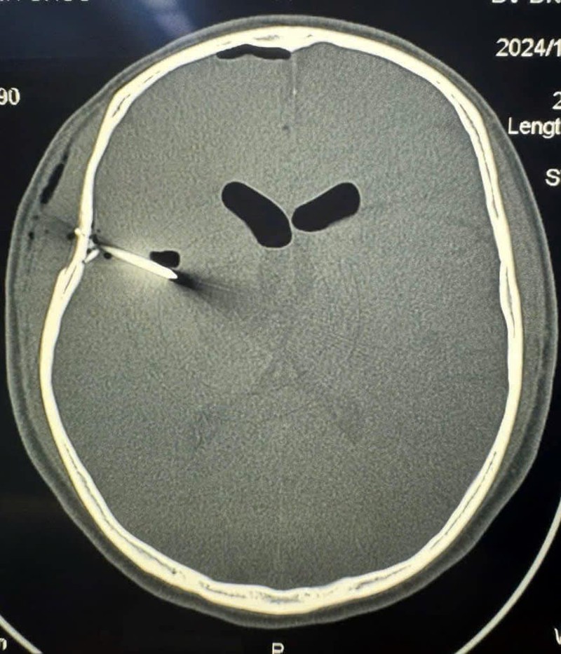 Cứu sống người đàn ông bị súng bắn đinh bắn thủng sọ não ảnh 2
